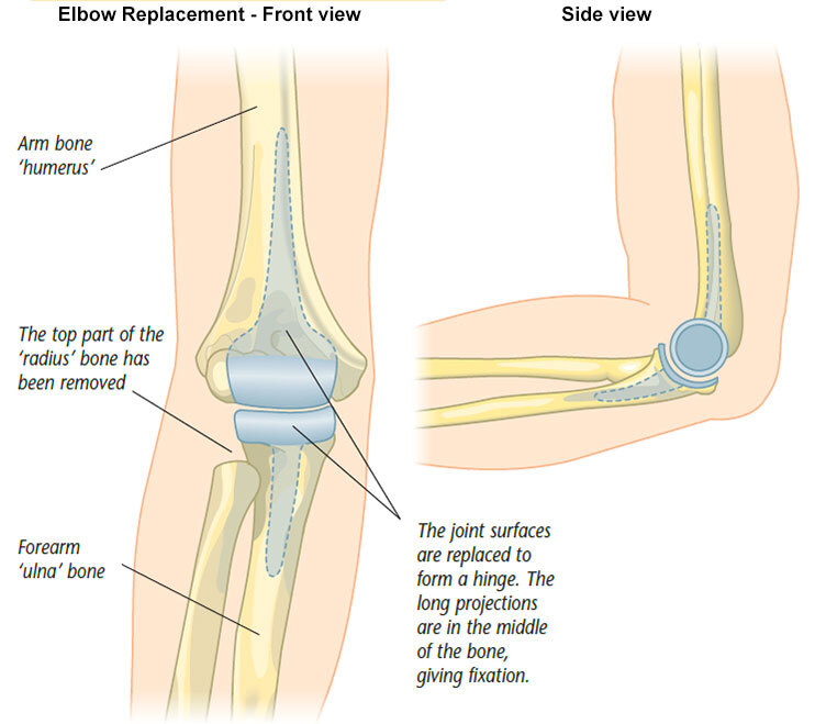 Elbow replacement