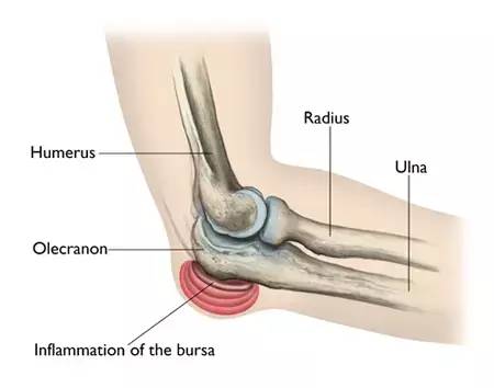 Knee Arthiritis