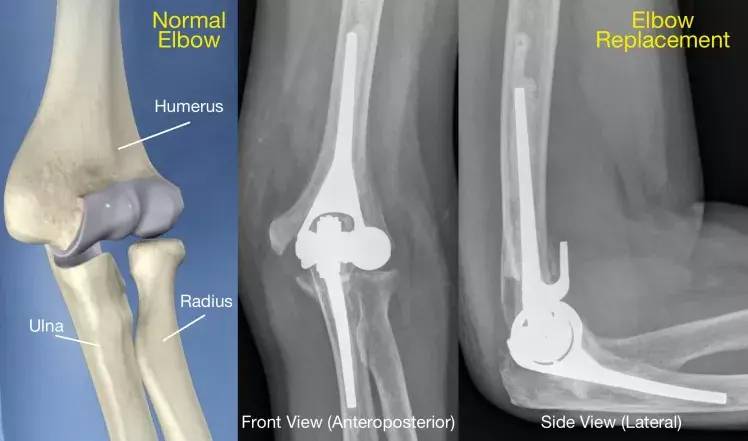 Knee Arthiritis