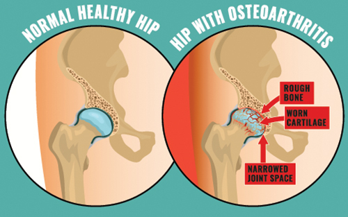 Hip surgery