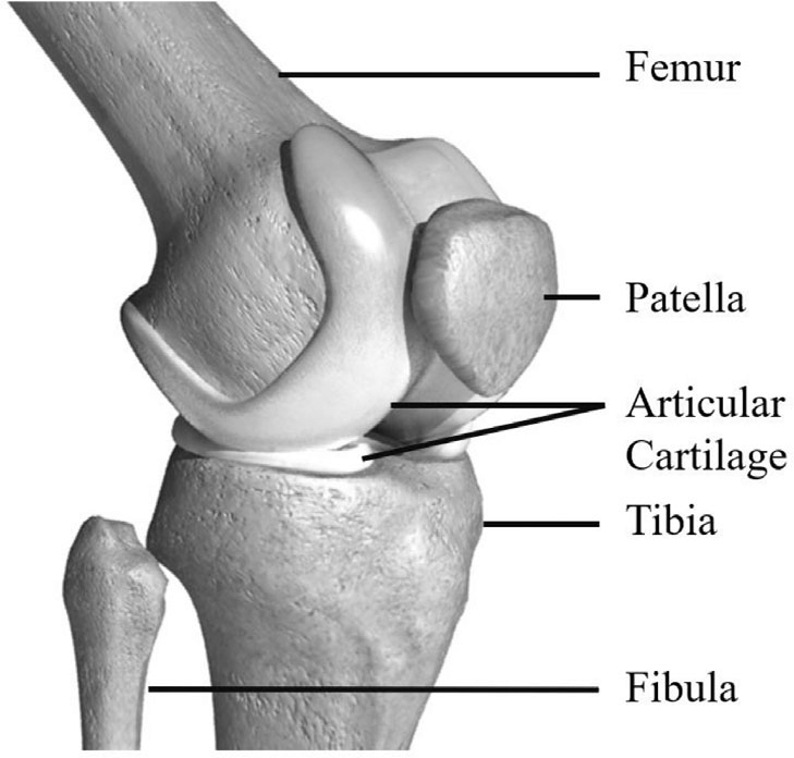 Knee Arthiritis