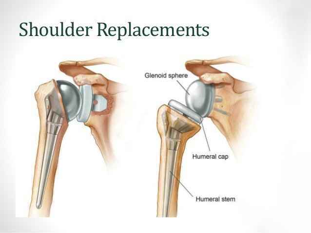 Shoulder surgery