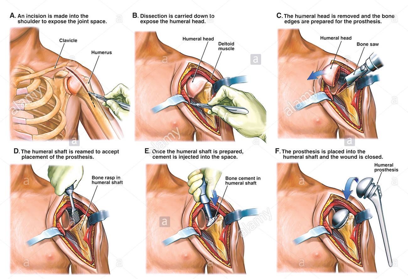 Shoulder surgery